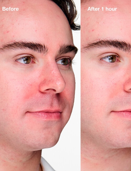 Clinique Anti-Blemish Clinical Advanced Clearing Gel, 10ml product photo View 06 L